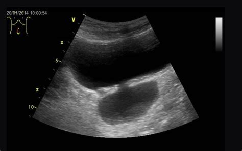 ultrasound for bladder problems